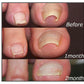 Corrigerende patches voor gezonde en mooie nagels 